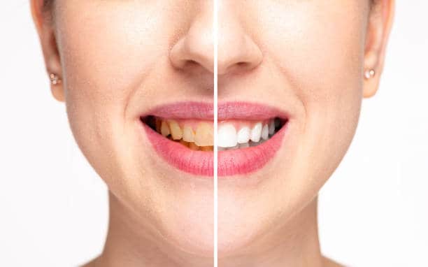 Teeth Whitening Milton Keynes Bedfordshire