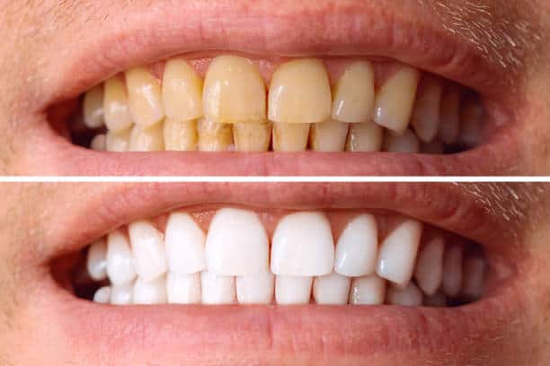 Laser White For Ever Bright – Get a Brighter, Whiter Smile with LA Teeth Whitening Bedfordshire