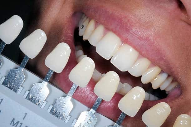 Get Natural and Stunning Smile with Teeth Whitening Results from LA Teeth Whitening Bedfordshire