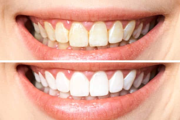 Achieve a Dazzling Smile for Your Special Day: A Guide to Wedding Teeth Whitening Bedfordshire