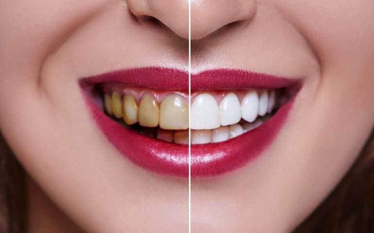 Teeth Whitening Ascot Windsor Bedfordshire